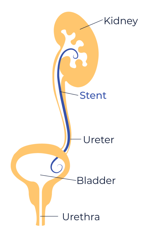 Coatings For Ureteral Stents 